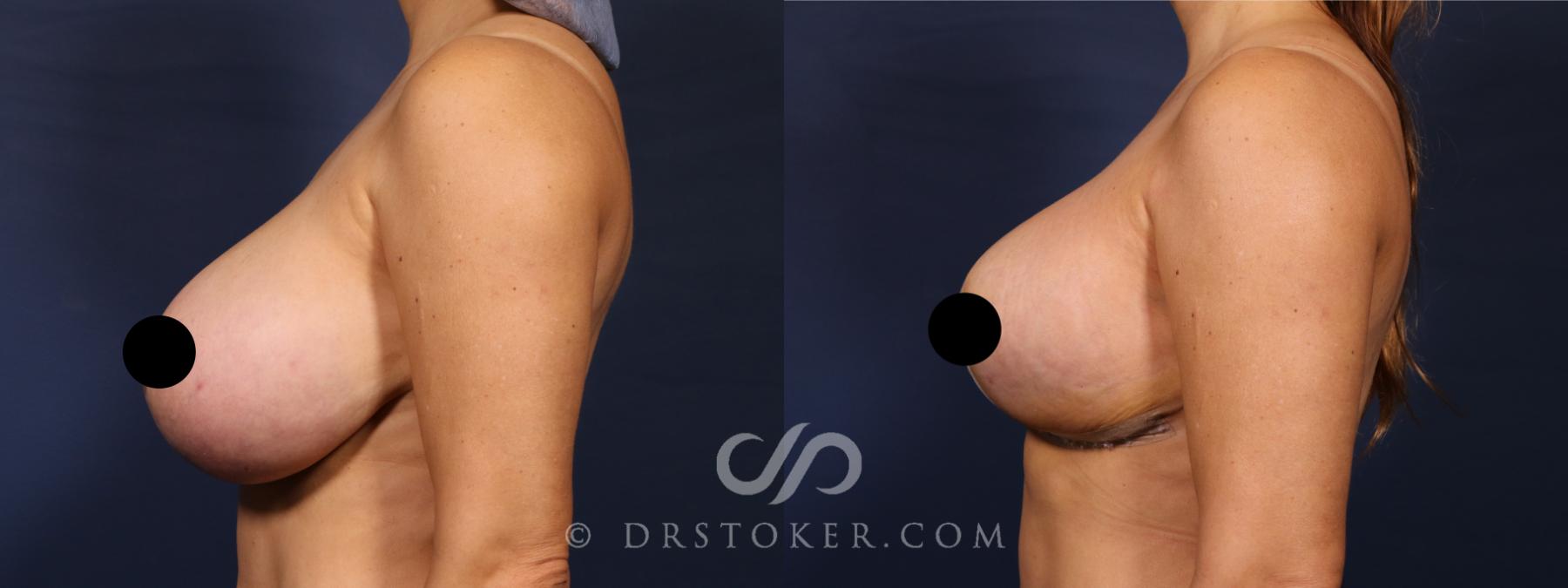 Before & After Breast Reduction (for Women) Case 2586 Left Side View in Los Angeles, CA