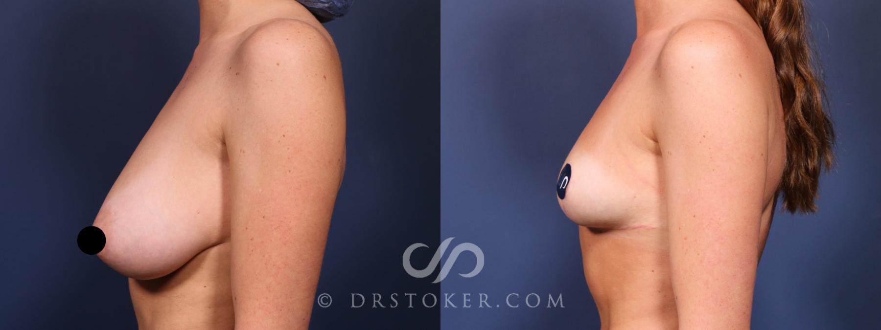 Before & After Breast Reduction (for Women) Case 2604 Left Side View in Los Angeles, CA