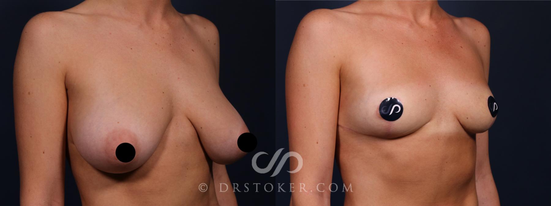 Before & After Breast Reduction (for Women) Case 2604 Right Oblique View in Los Angeles, CA