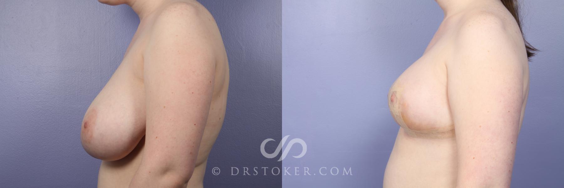 Before & After Breast Reduction (for Women) Case 411 View #3 View in Los Angeles, CA