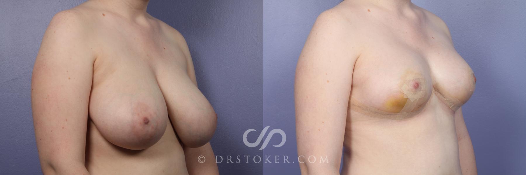 Before & After Breast Reduction (for Women) Case 411 View #4 View in Los Angeles, CA
