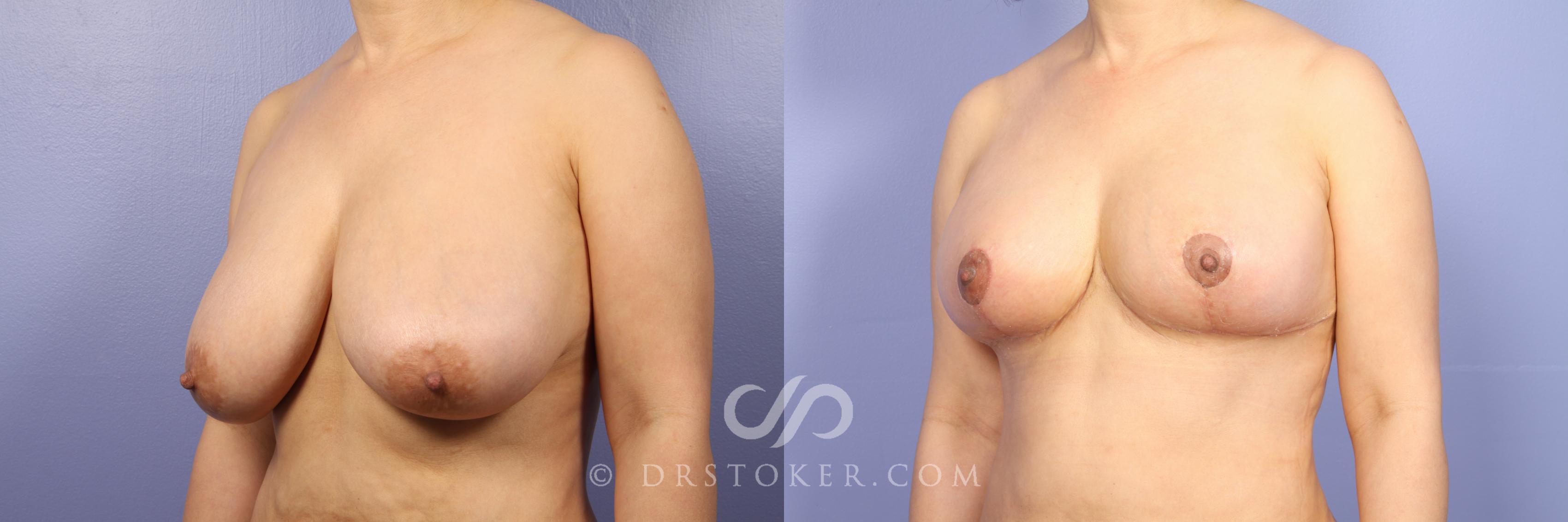 Before & After Breast Reduction (for Women) Case 412 View #2 View in Los Angeles, CA