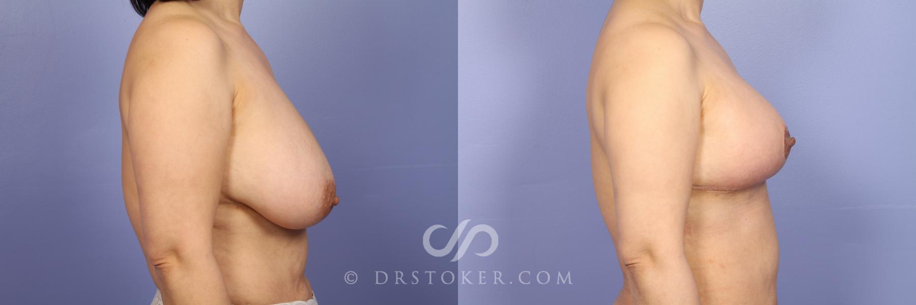 Before & After Breast Reduction (for Women) Case 412 View #3 View in Los Angeles, CA