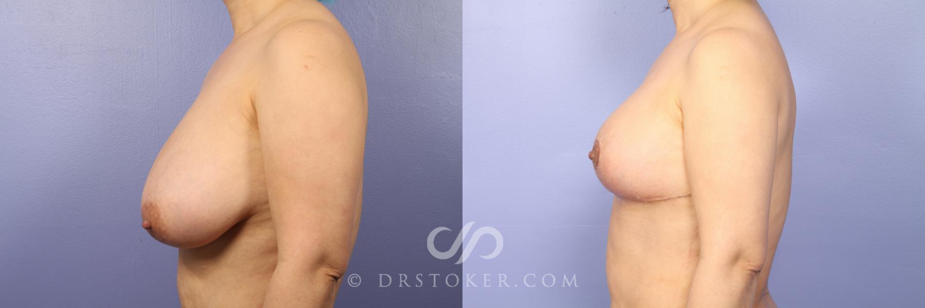 Before & After Breast Reduction (for Women) Case 412 View #4 View in Los Angeles, CA