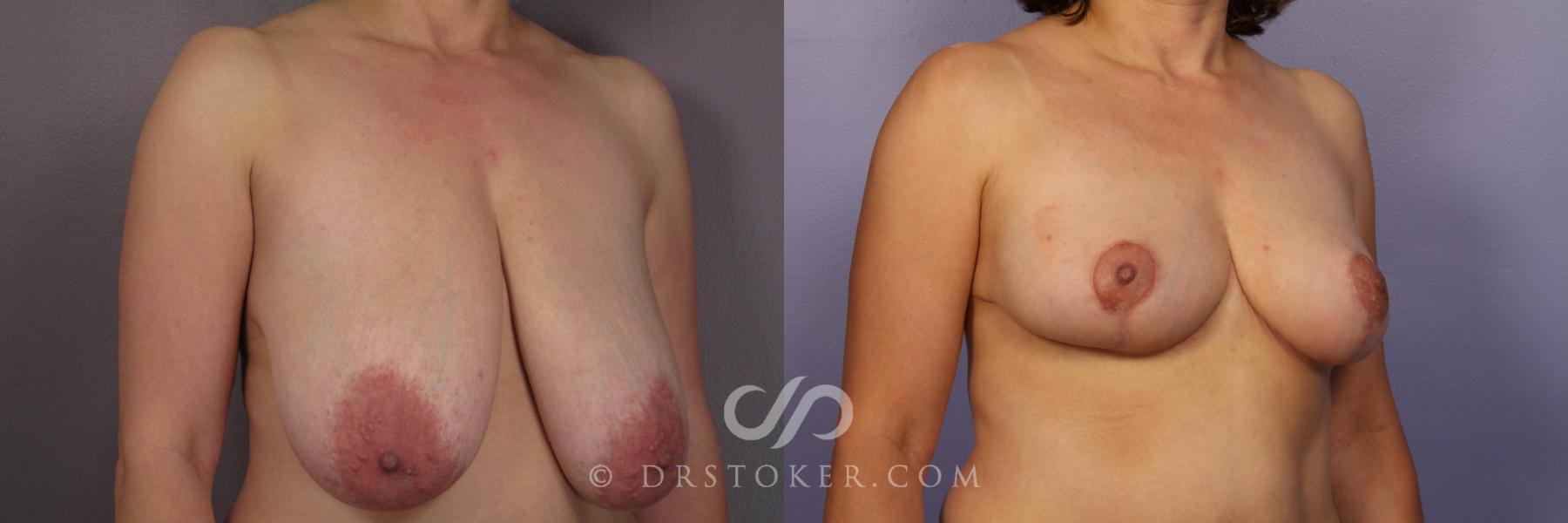 Before & After Breast Reduction (for Women) Case 418 View #2 View in Los Angeles, CA