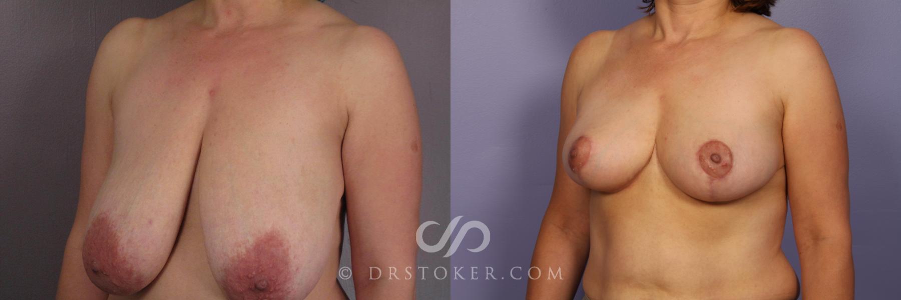 Before & After Breast Reduction (for Women) Case 418 View #4 View in Los Angeles, CA