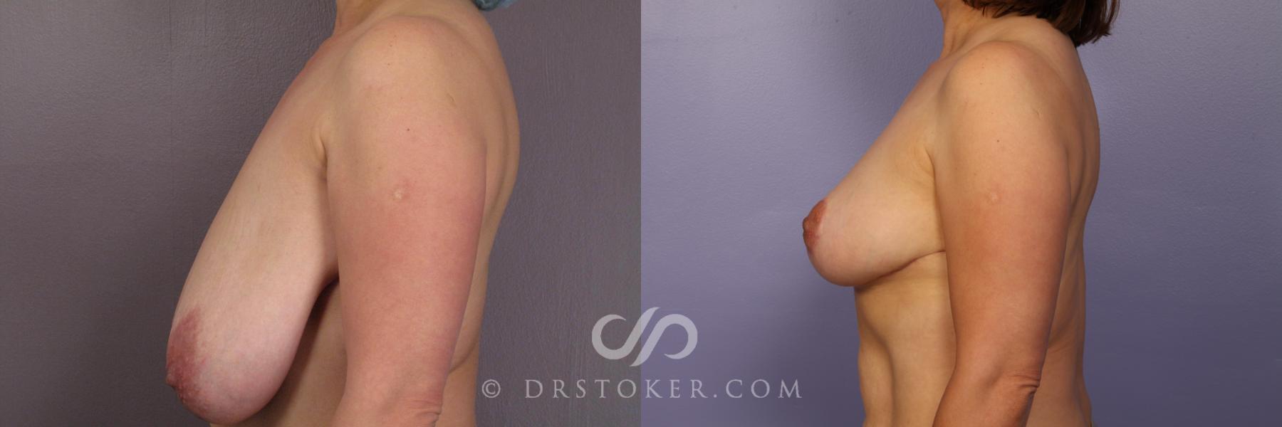 Before & After Breast Reduction (for Women) Case 418 View #5 View in Los Angeles, CA