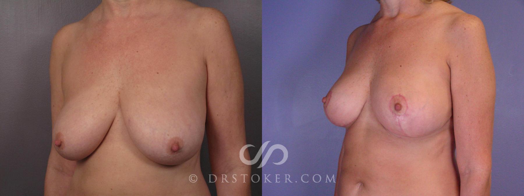 Before & After Breast Reduction (for Women) Case 425 View #2 View in Los Angeles, CA