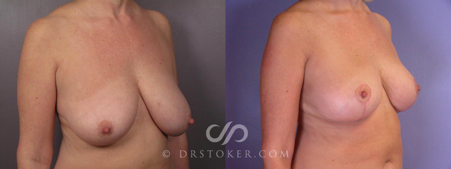 Before & After Breast Lift Case 425 View #3 View in Los Angeles, CA