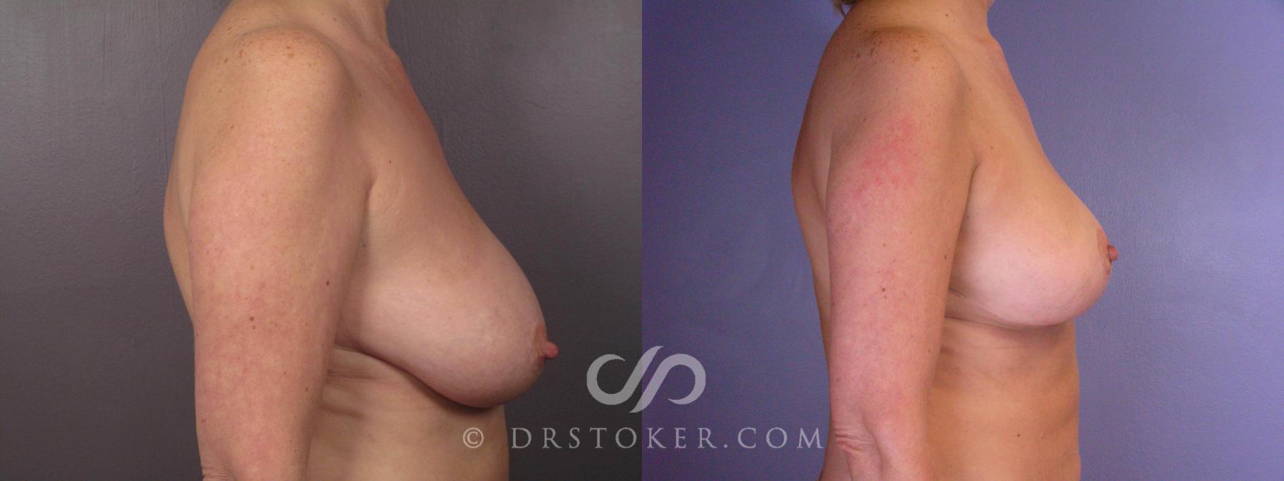 Before & After Breast Reduction (for Women) Case 425 View #4 View in Los Angeles, CA