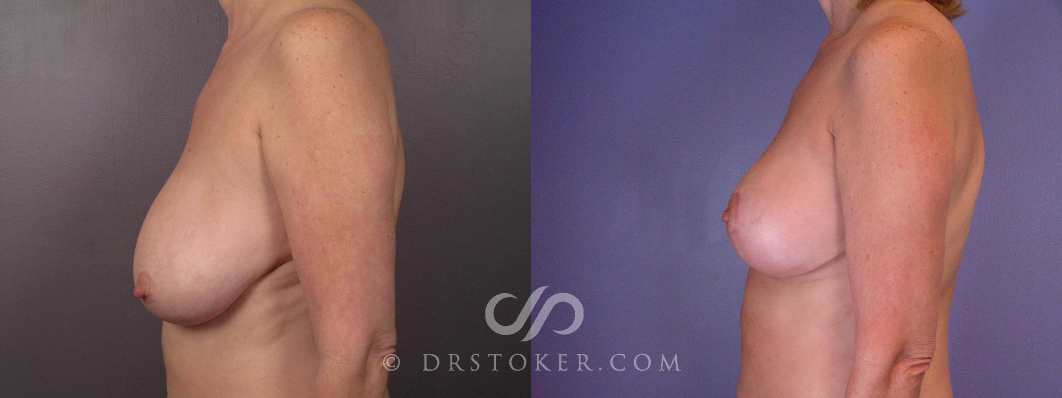 Before & After Breast Reduction (for Women) Case 425 View #5 View in Los Angeles, CA