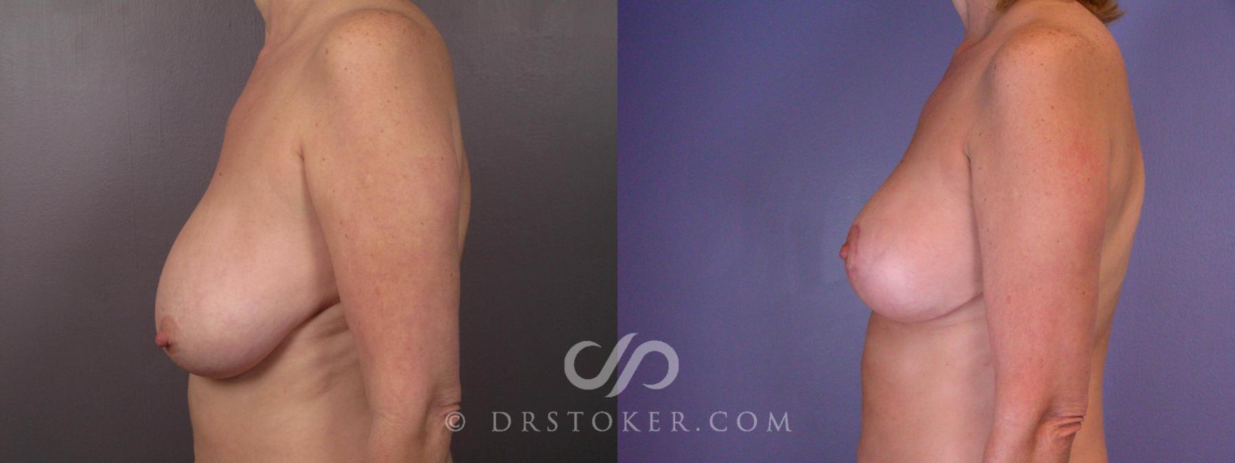 Before & After Breast Lift Case 425 View #5 View in Los Angeles, CA