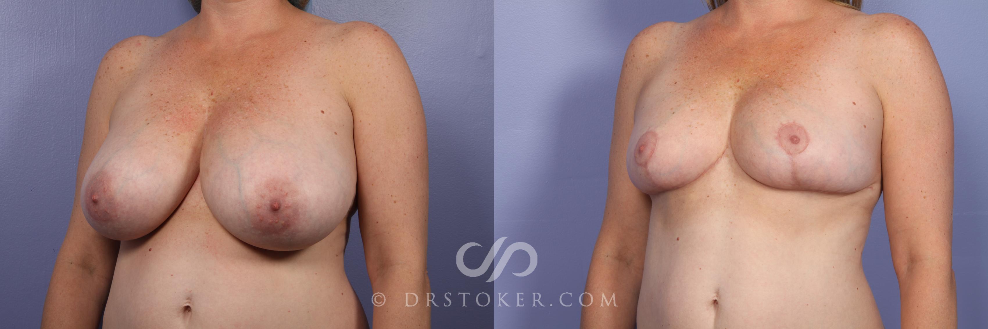 Before & After Breast Reduction (for Women) Case 455 View #4 View in Los Angeles, CA