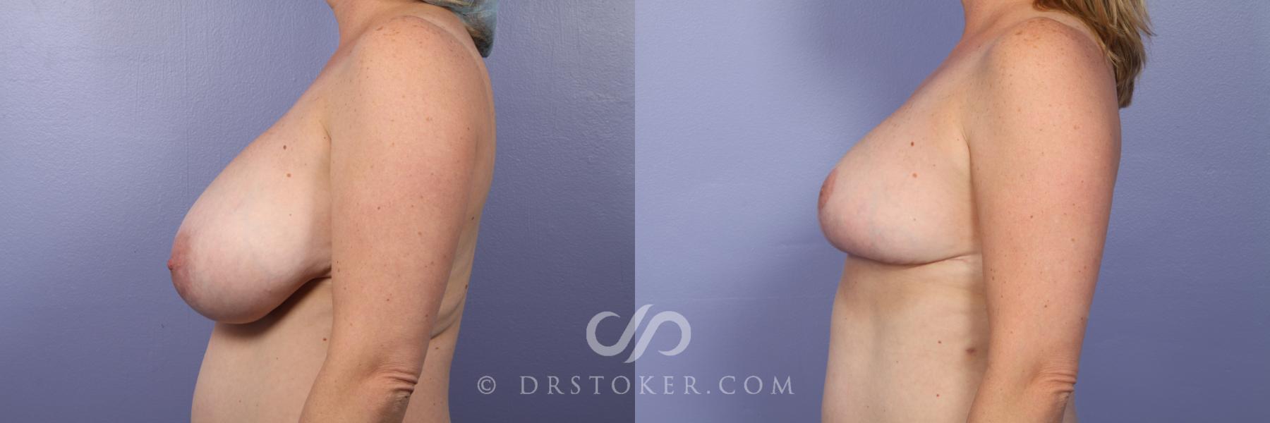 Before & After Breast Reduction (for Women) Case 455 View #5 View in Los Angeles, CA