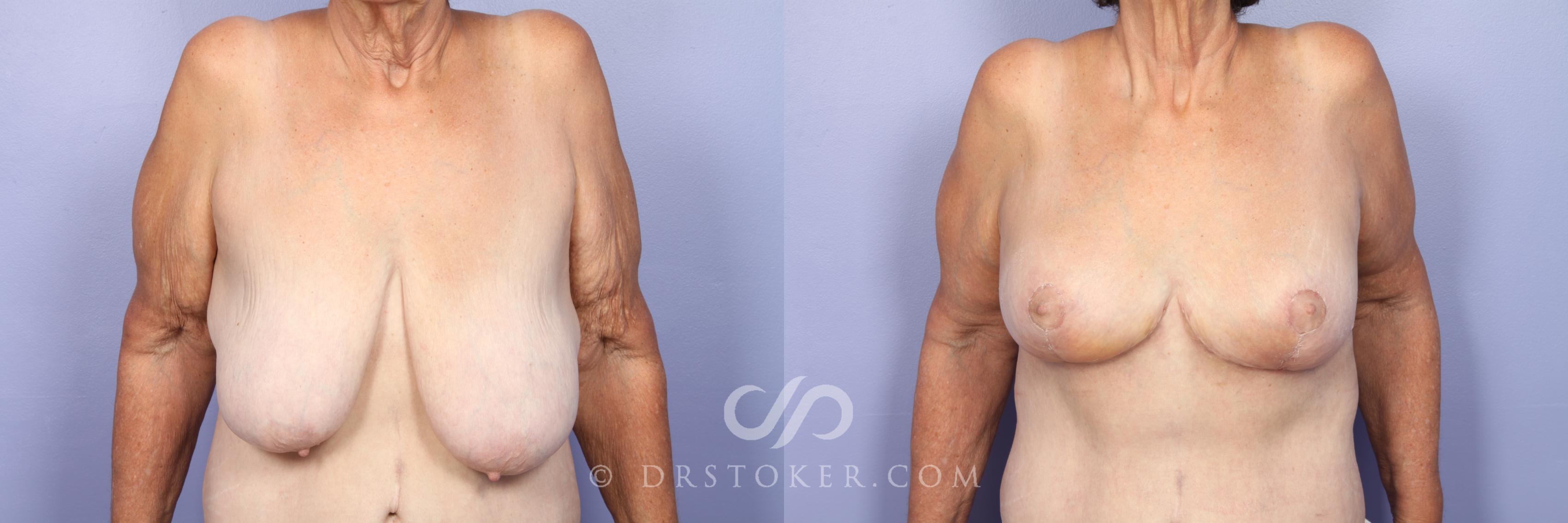 Before & After Breast Lift Case 515 View #1 View in Los Angeles, CA