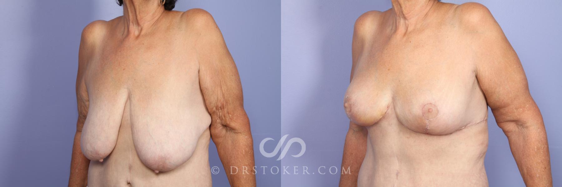 Before & After Breast Reduction (for Women) Case 515 View #2 View in Los Angeles, CA