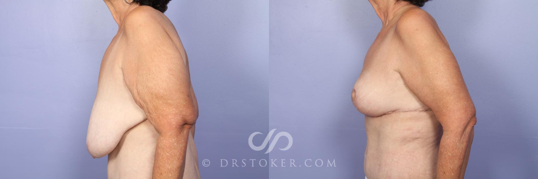 Before & After Breast Lift Case 515 View #3 View in Los Angeles, CA