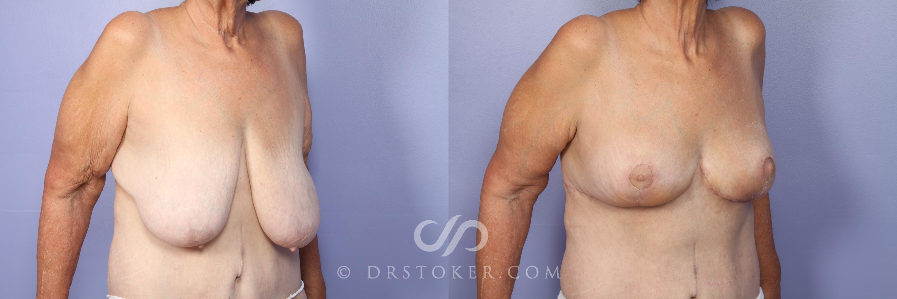 Before & After Breast Reduction (for Women) Case 515 View #4 View in Los Angeles, CA