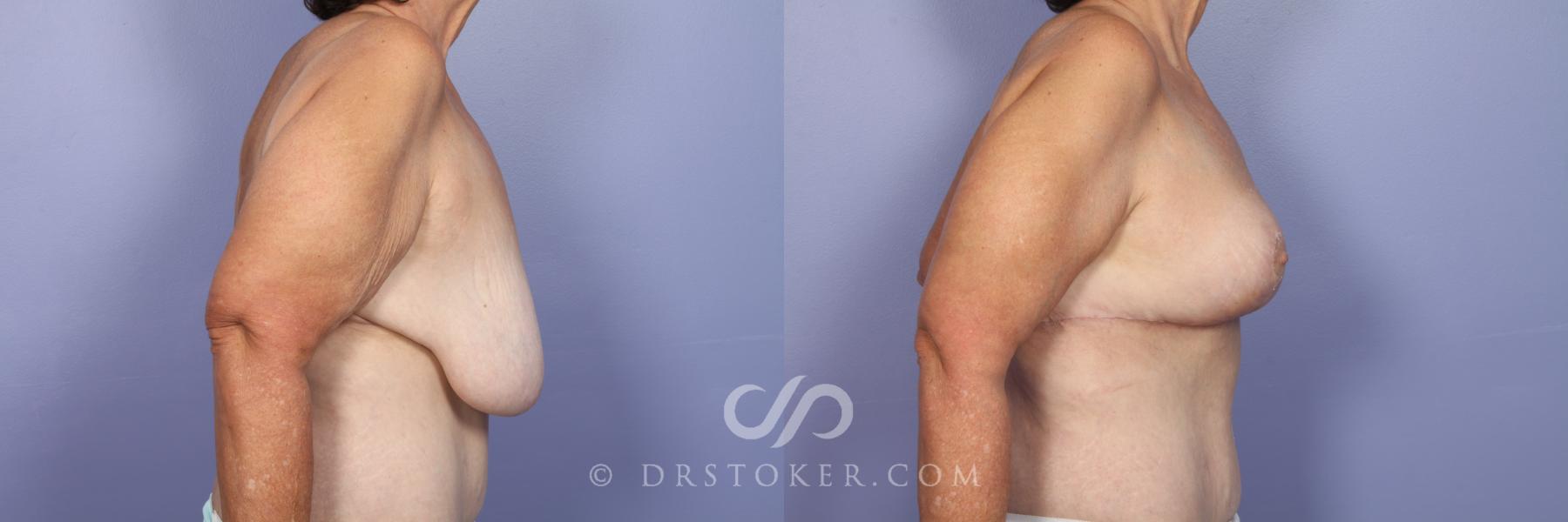 Before & After Breast Lift Case 515 View #5 View in Los Angeles, CA