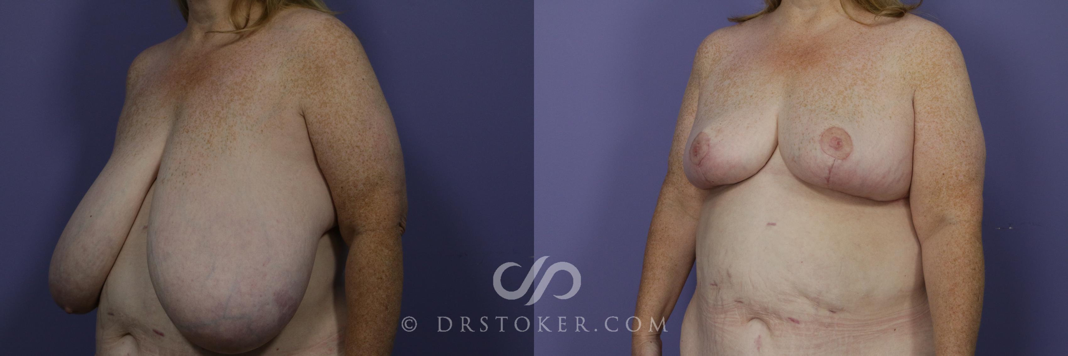 Before & After Breast Reduction (for Women) Case 869 View #2 View in Los Angeles, CA