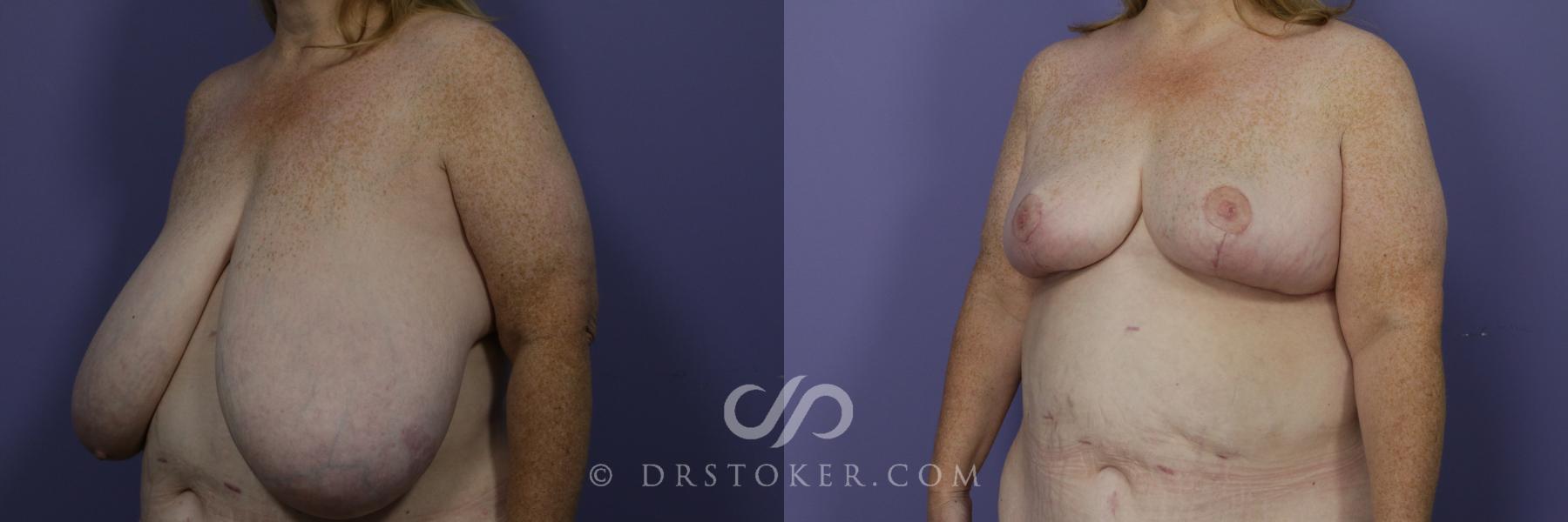 Before & After Breast Reduction (for Women) Case 869 View #2 View in Los Angeles, CA