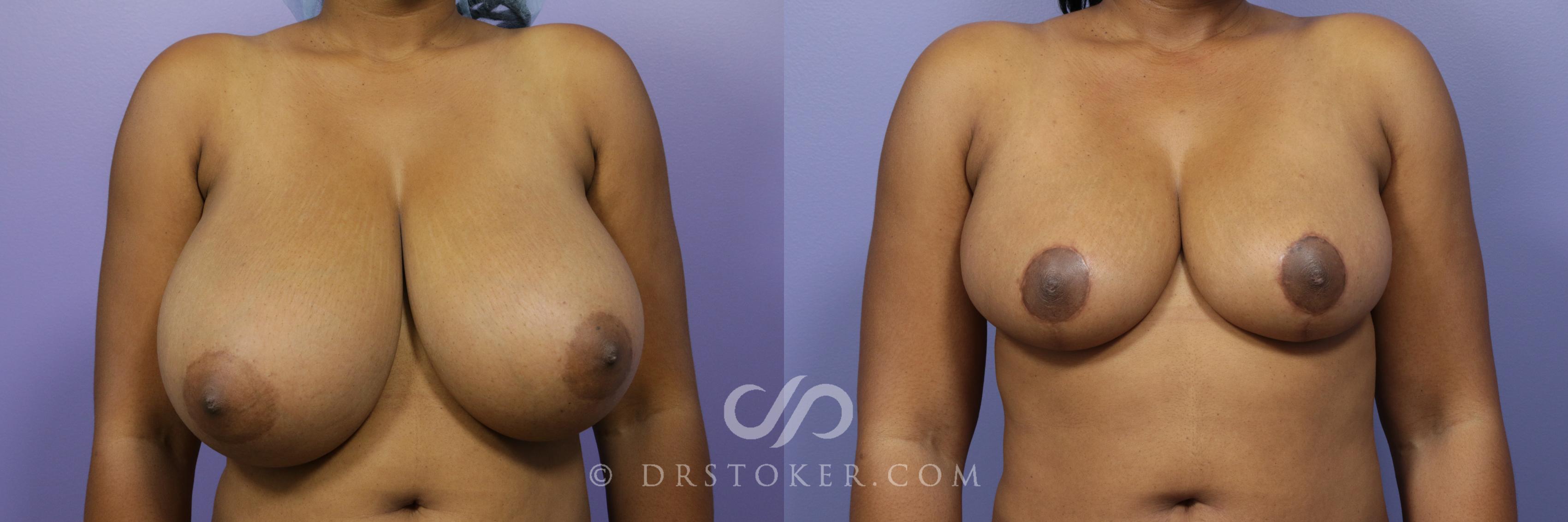 Before & After Breast Reduction (for Women) Case 870 View #1 View in Los Angeles, CA