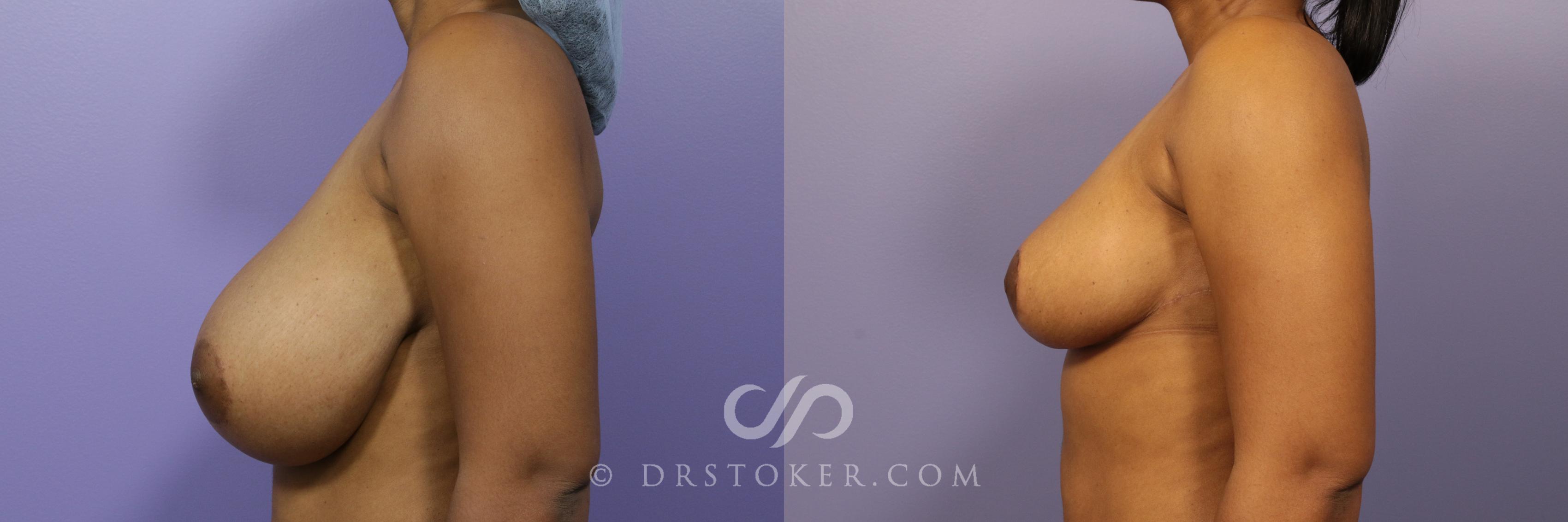 Before & After Breast Reduction (for Women) Case 870 View #3 View in Los Angeles, CA