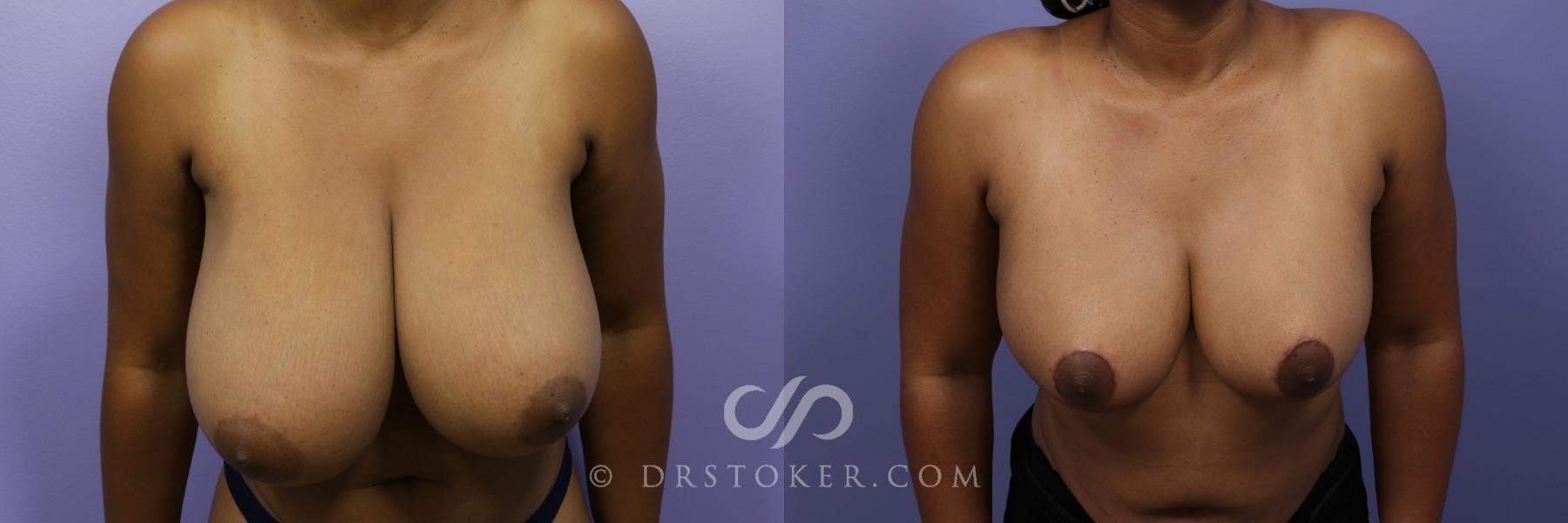 Before & After Breast Reduction (for Women) Case 871 View #1 View in Los Angeles, CA