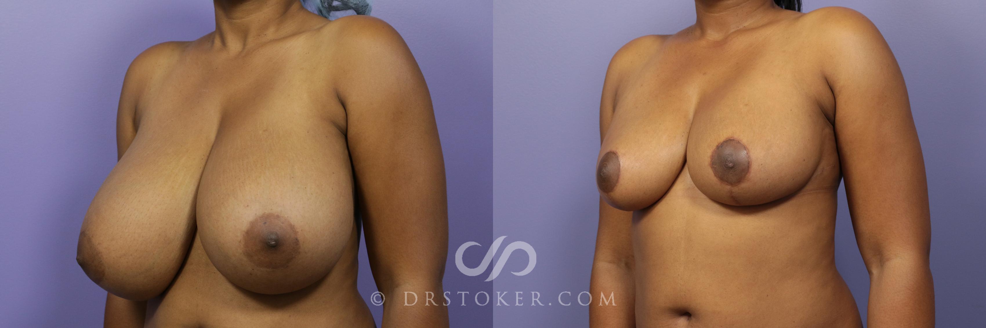 Before & After Breast Reduction (for Women) Case 871 View #2 View in Los Angeles, CA