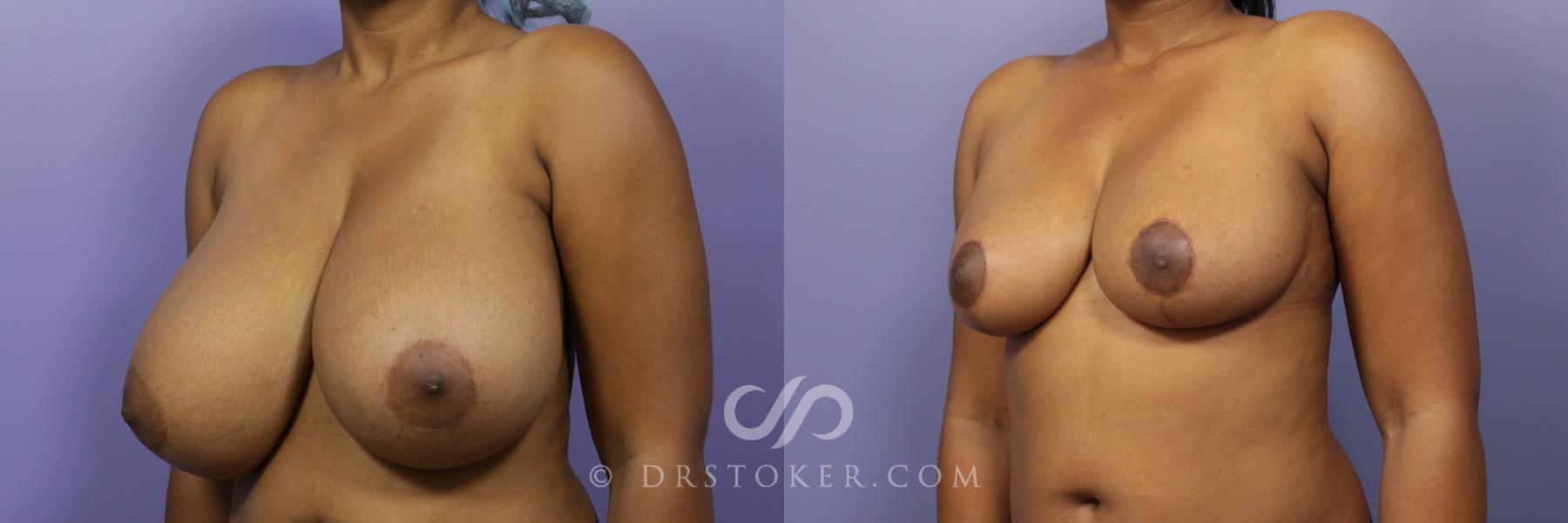 Before & After Breast Reduction (for Women) Case 871 View #2 View in Los Angeles, CA