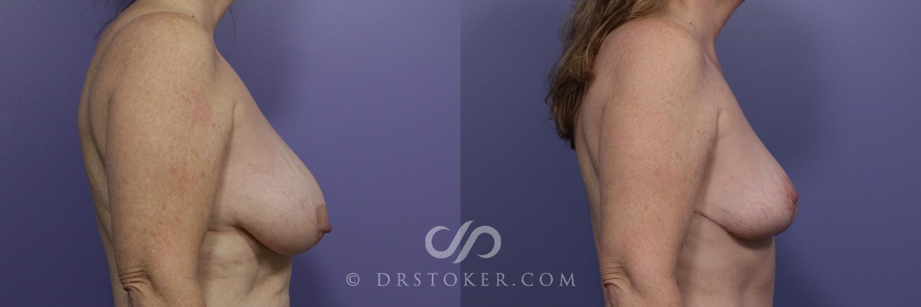 Before & After Breast Reduction (for Women) Case 872 View #3 View in Los Angeles, CA