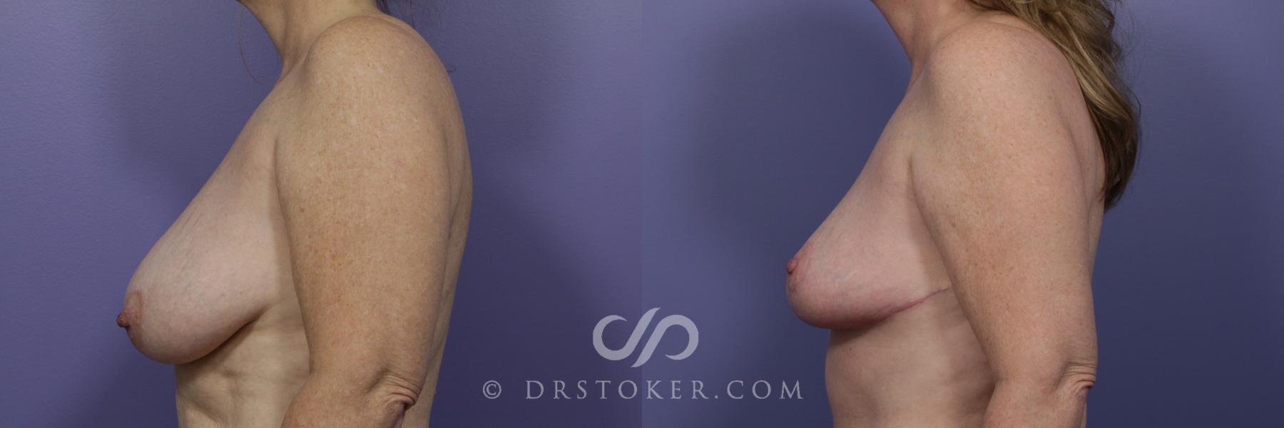 Before & After Breast Reduction (for Women) Case 872 View #5 View in Los Angeles, CA