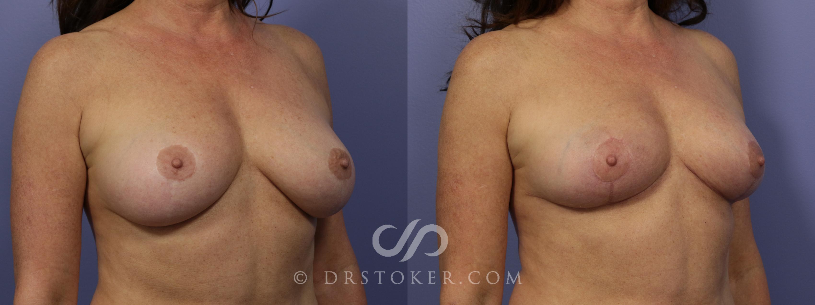 Before & After Breast Reduction (for Women) Case 875 View #2 View in Los Angeles, CA