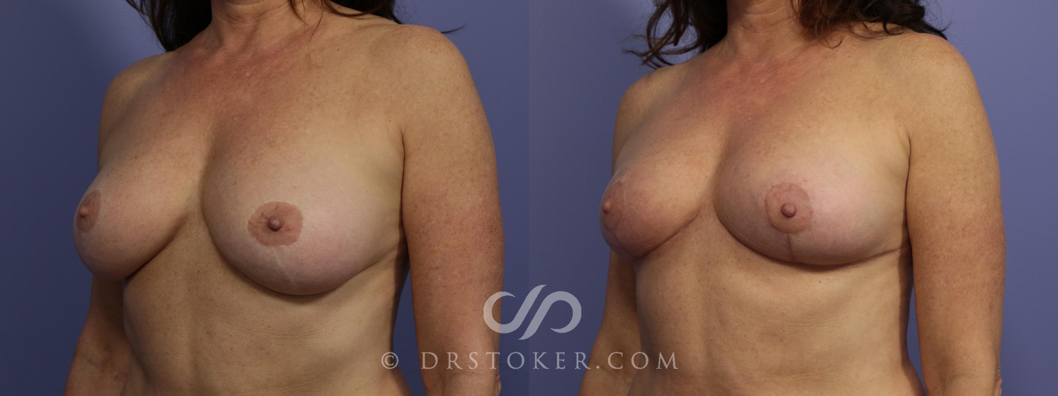 Before & After Breast Reduction (for Women) Case 875 View #3 View in Los Angeles, CA