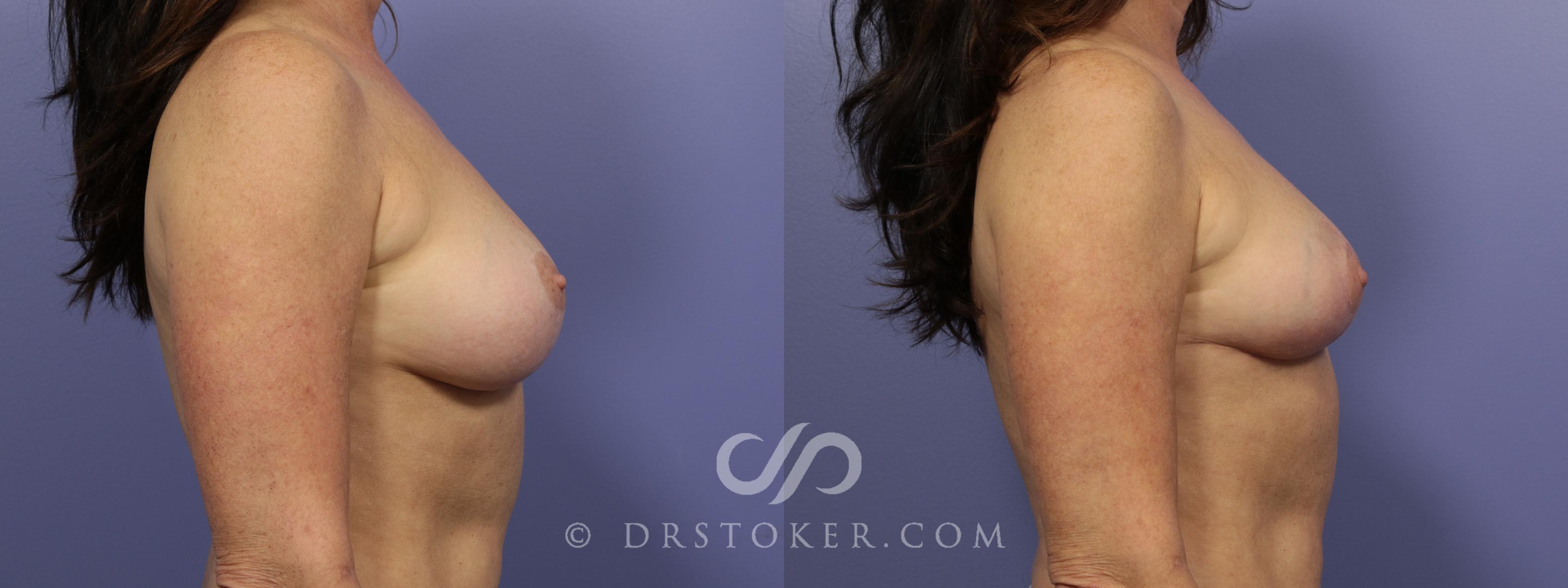 Before & After Breast Reduction (for Women) Case 875 View #4 View in Los Angeles, CA