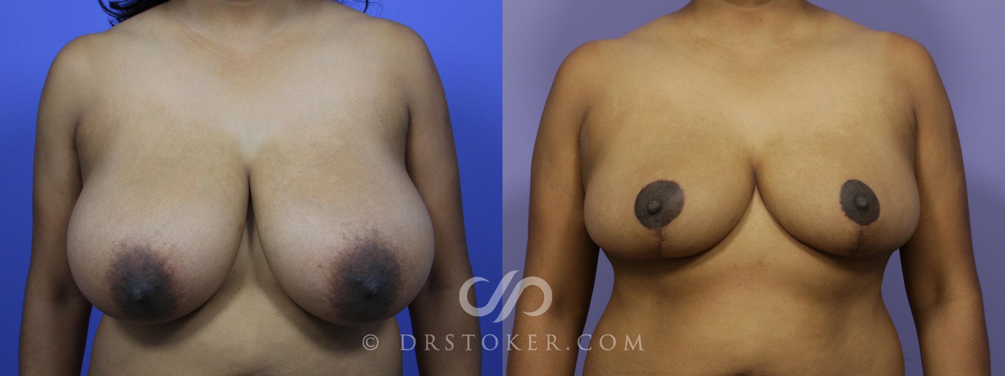 Before & After Breast Reduction (for Women) Case 877 View #1 View in Los Angeles, CA