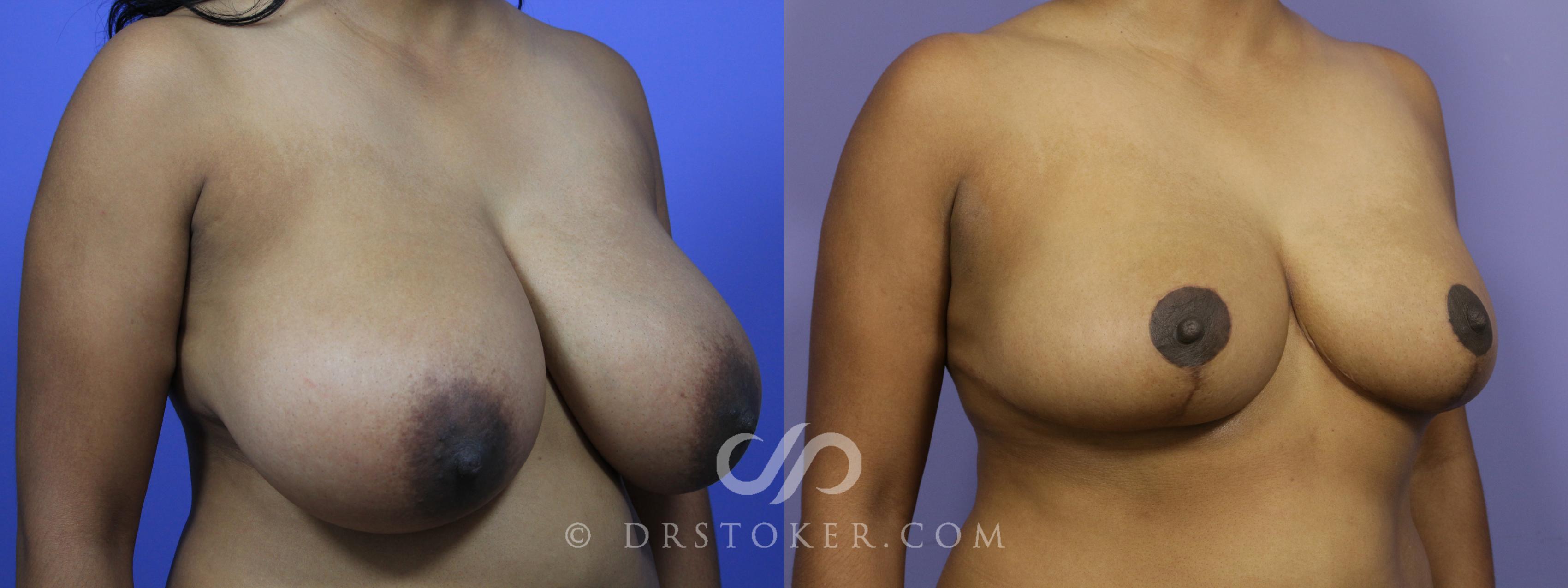 Before & After Breast Reduction (for Women) Case 877 View #2 View in Los Angeles, CA