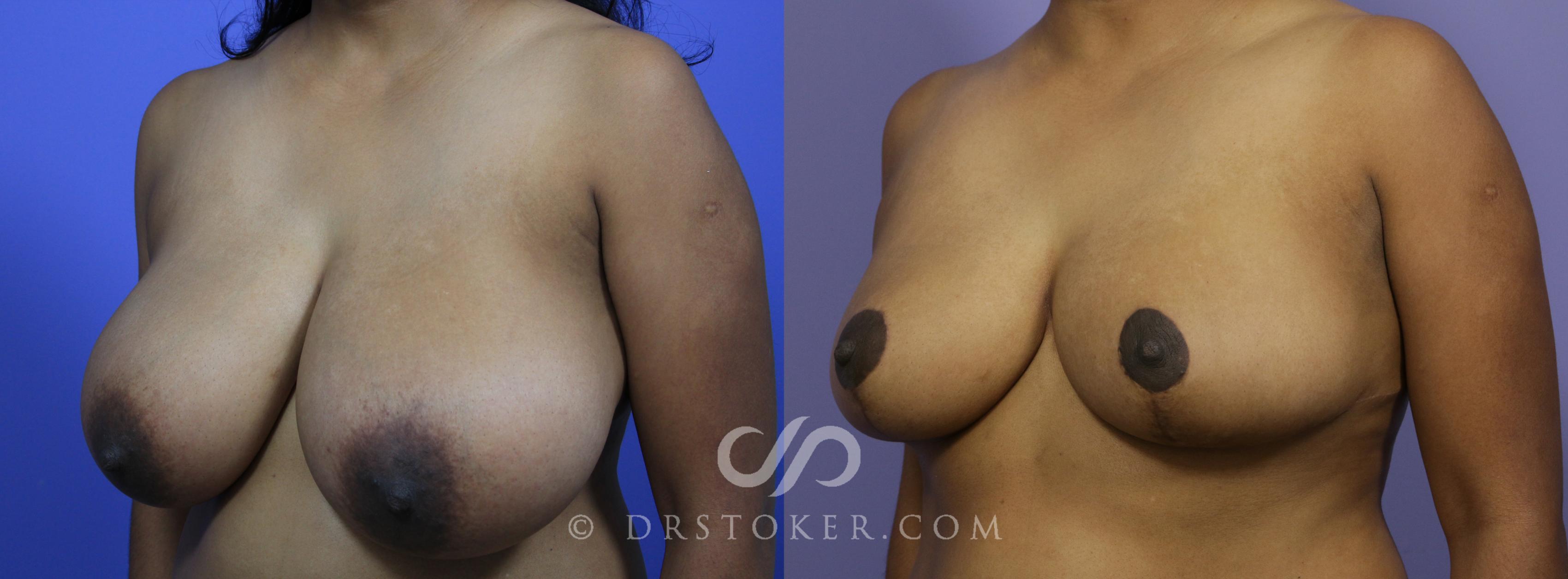 Before & After Breast Reduction (for Women) Case 877 View #3 View in Los Angeles, CA