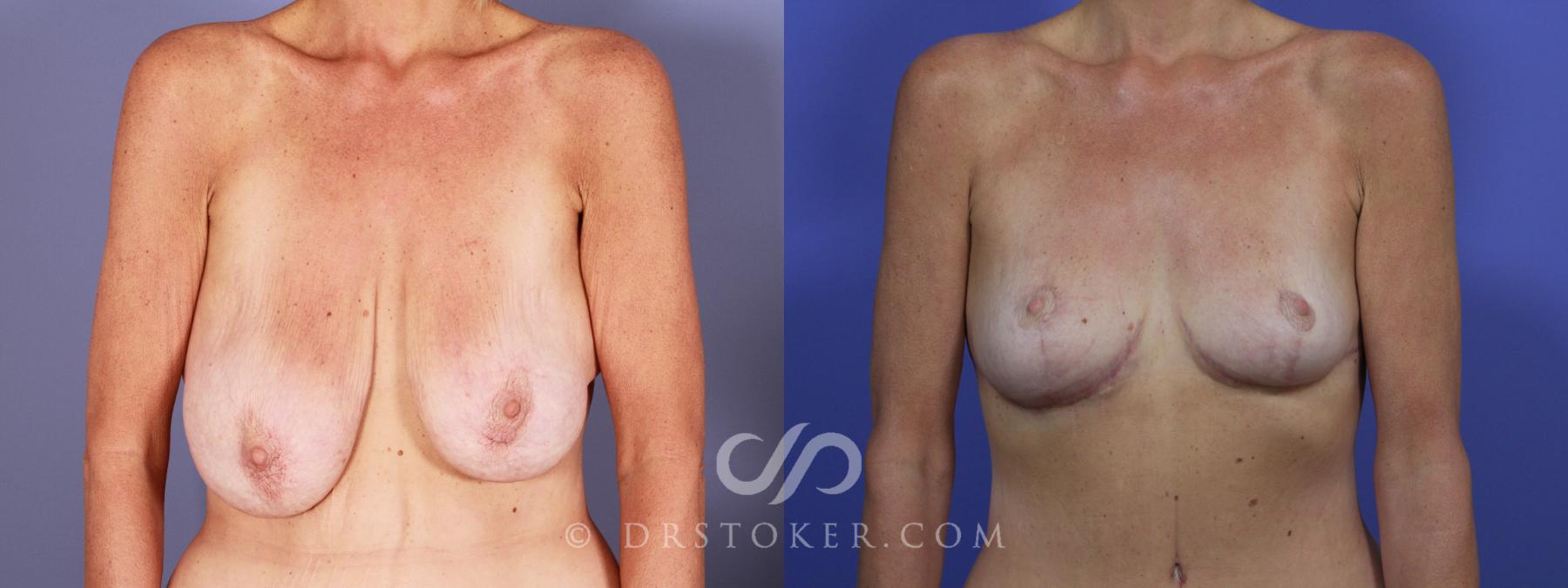Before & After Breast Reduction (for Women) Case 878 View #1 View in Los Angeles, CA