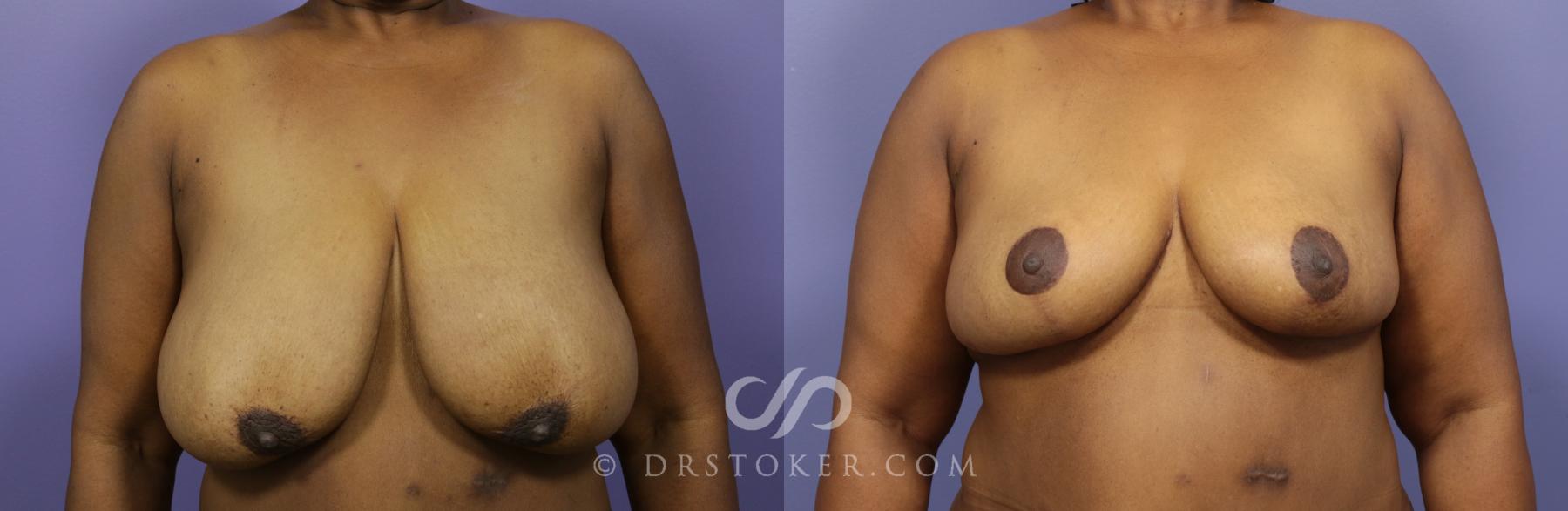 Before & After Breast Reduction (for Women) Case 880 View #1 View in Los Angeles, CA
