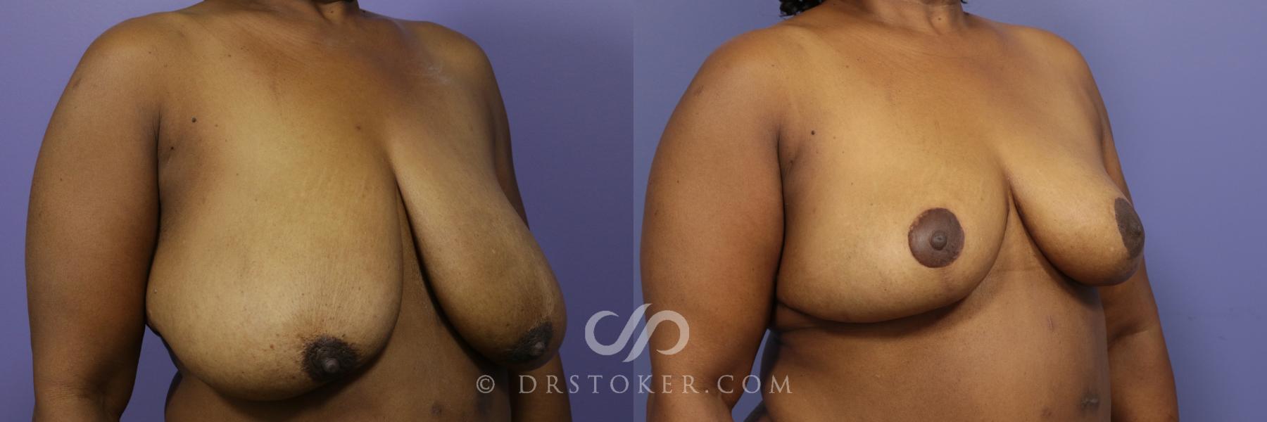 Before & After Breast Reduction (for Women) Case 880 View #2 View in Los Angeles, CA