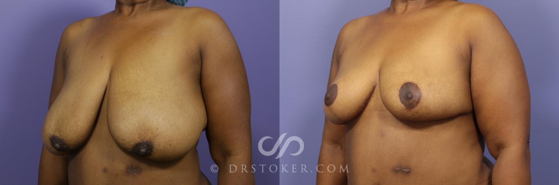 Before & After Breast Reduction (for Women) Case 880 View #3 View in Los Angeles, CA