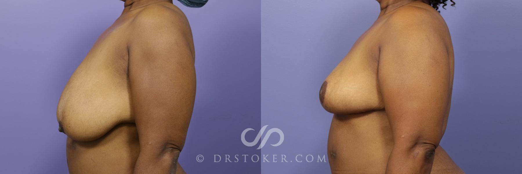 Before & After Breast Reduction (for Women) Case 880 View #5 View in Los Angeles, CA