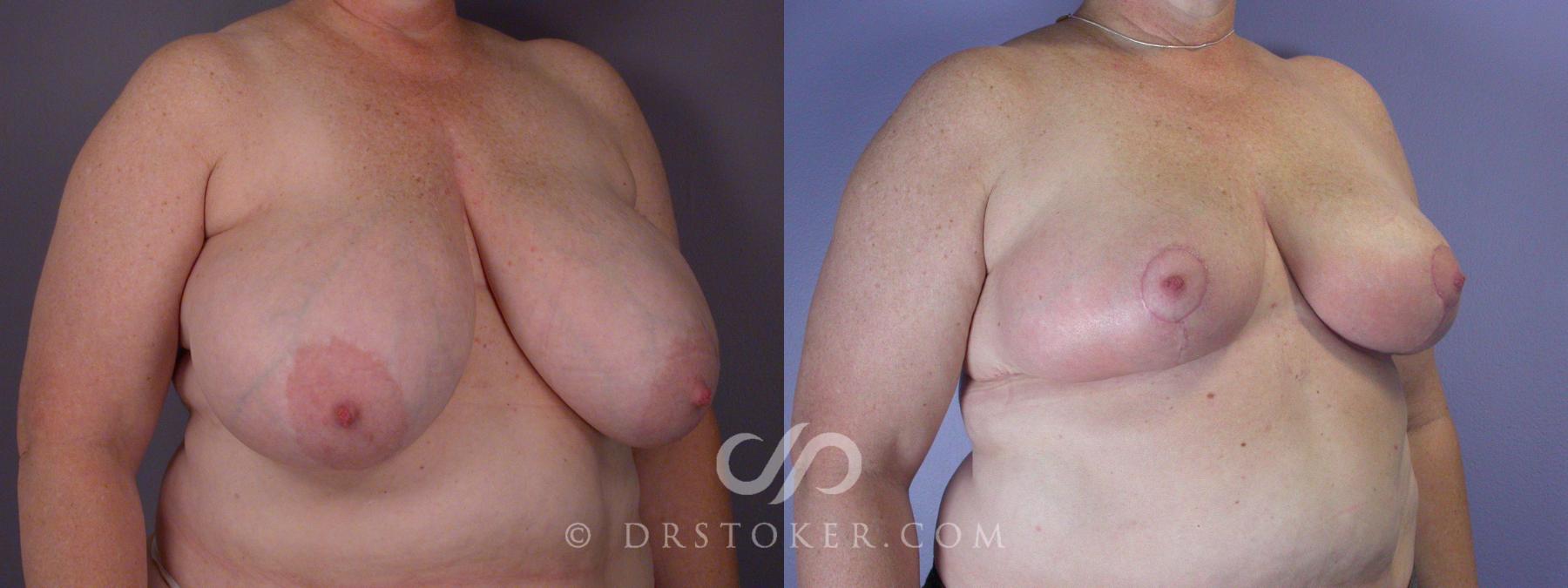 Before & After Breast Reduction (for Women) Case 881 View #2 View in Los Angeles, CA