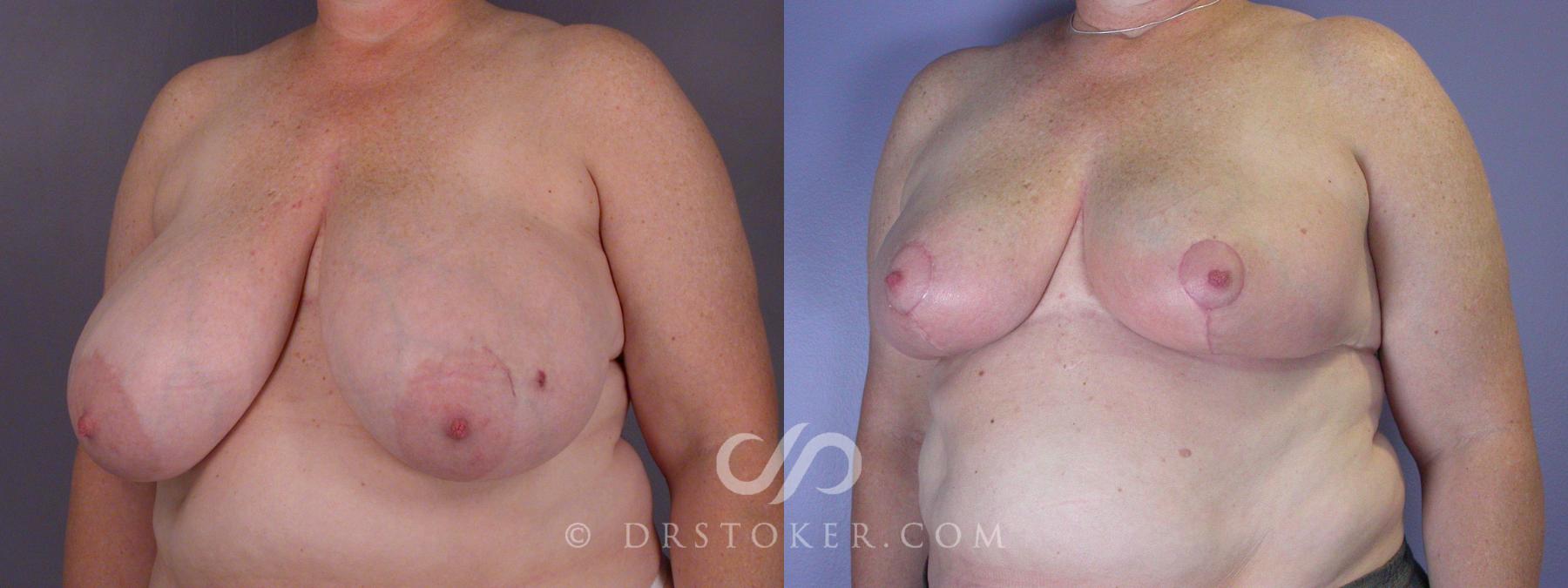 Before & After Breast Reduction (for Women) Case 881 View #3 View in Los Angeles, CA