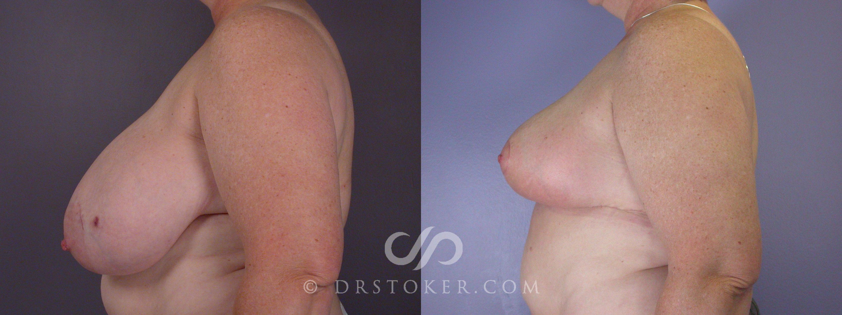 Before & After Breast Reduction (for Women) Case 881 View #4 View in Los Angeles, CA