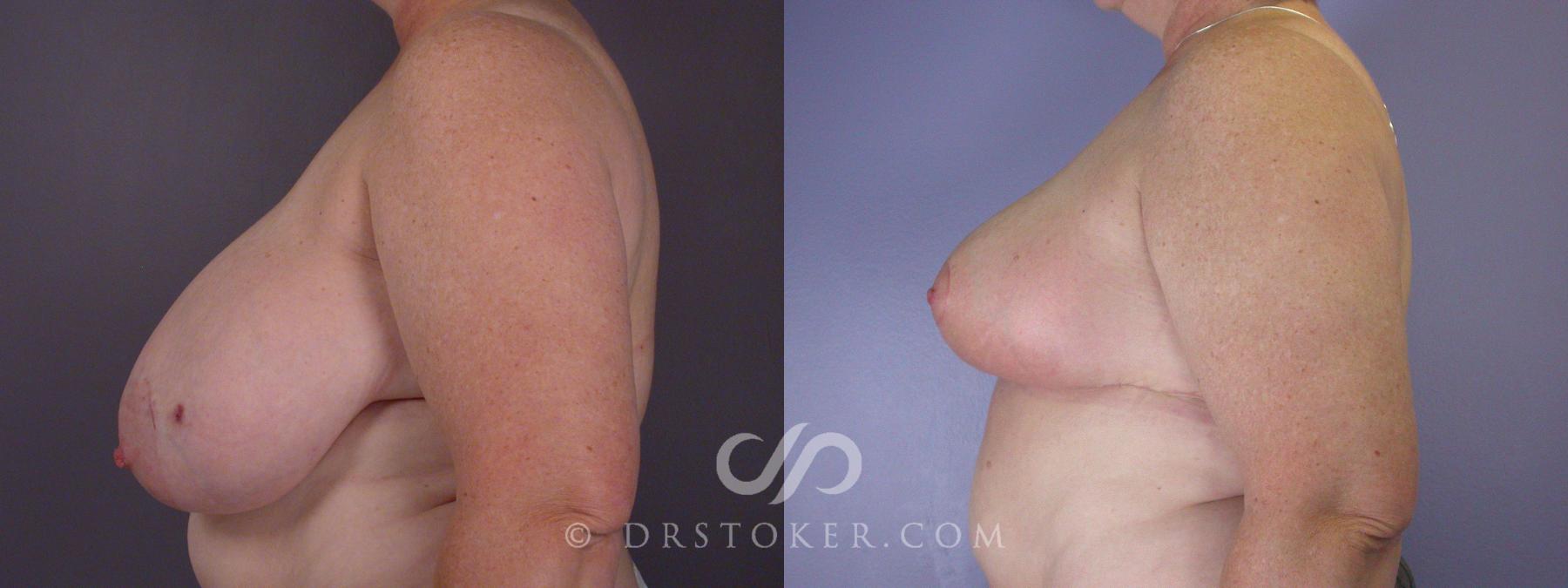 Before & After Breast Reduction (for Women) Case 881 View #4 View in Los Angeles, CA