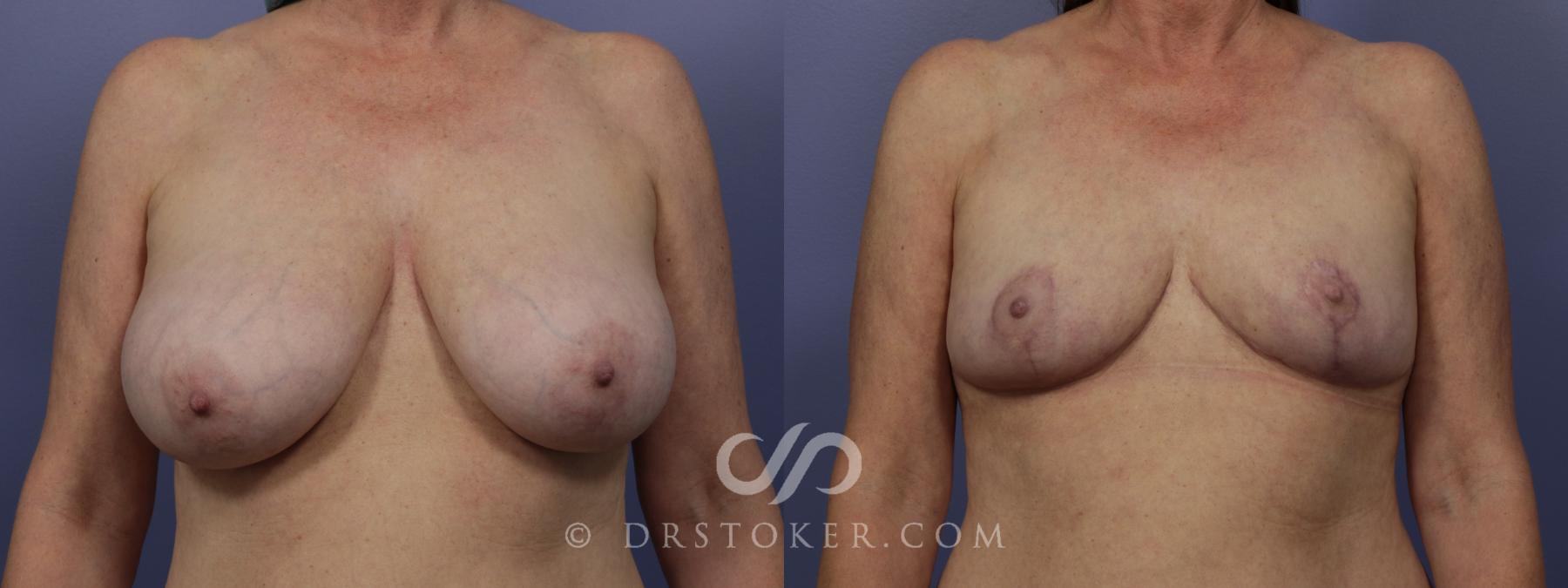 Before & After Breast Reduction (for Women) Case 882 View #1 View in Los Angeles, CA