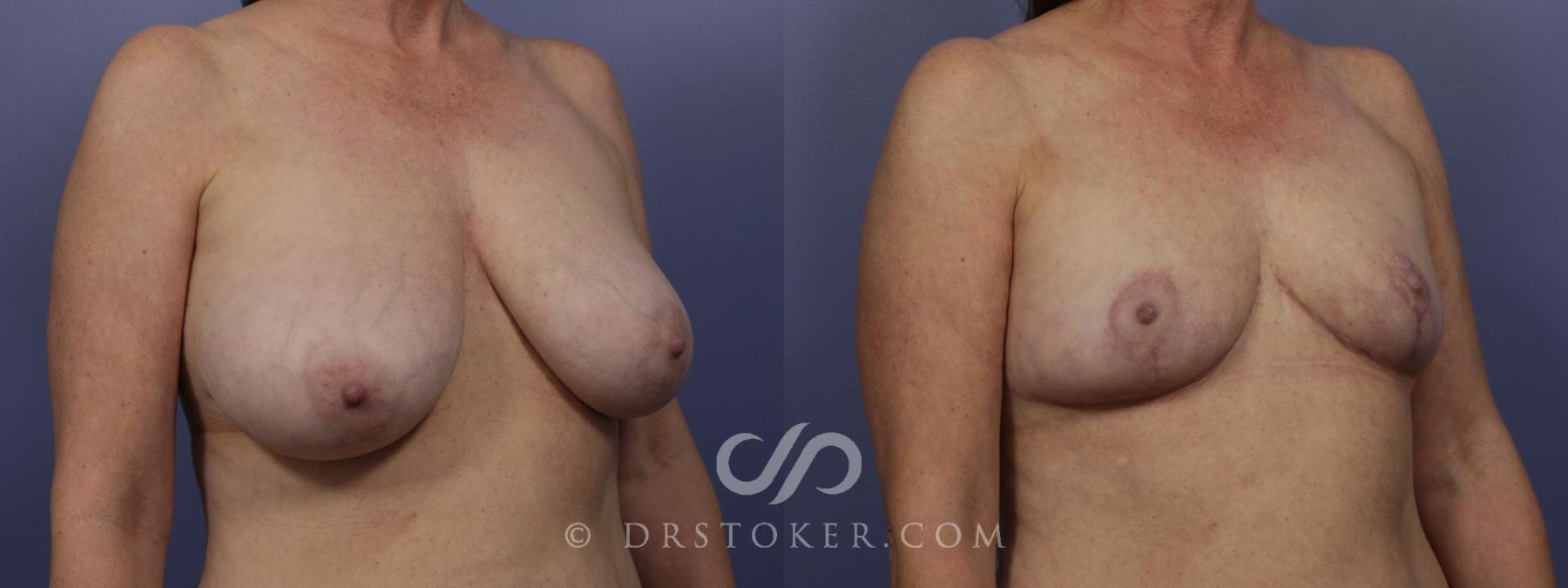 Before & After Breast Reduction (for Women) Case 882 View #2 View in Los Angeles, CA