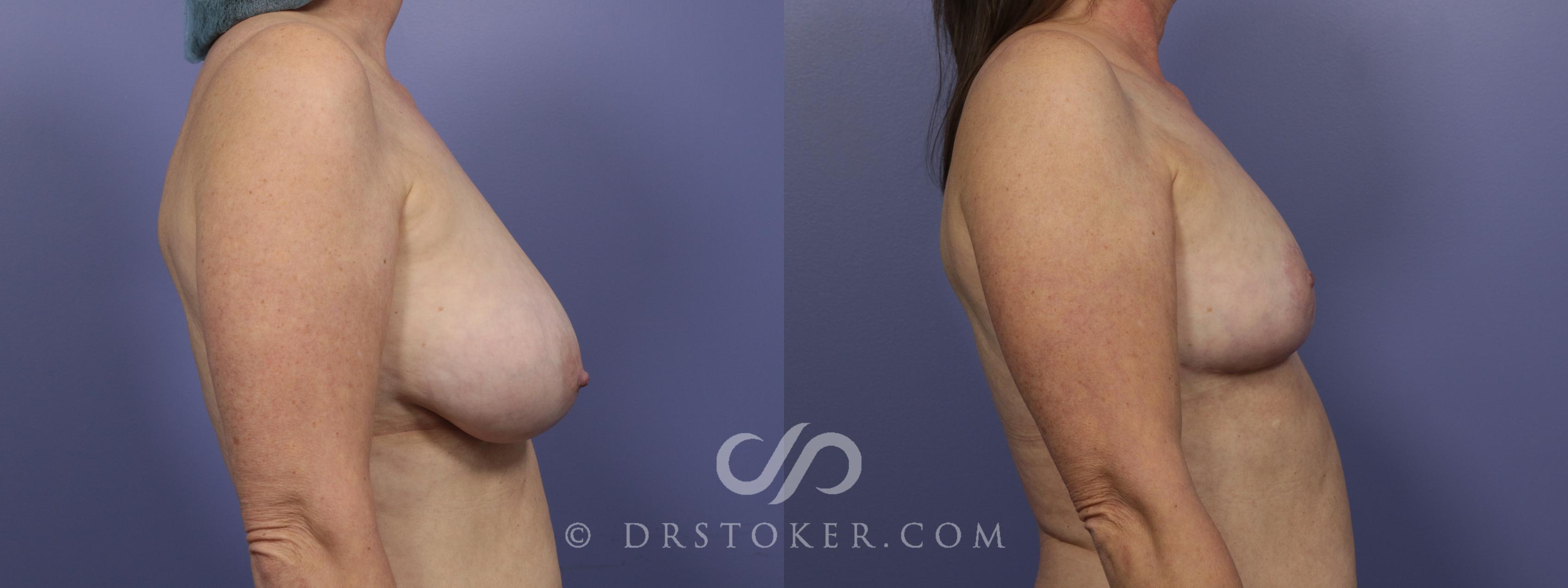 Before & After Breast Reduction (for Women) Case 882 View #3 View in Los Angeles, CA